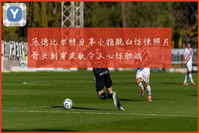 范德比尔特分享小指脱臼惊悚照片骨头刺穿皮肤令人心惊胆战